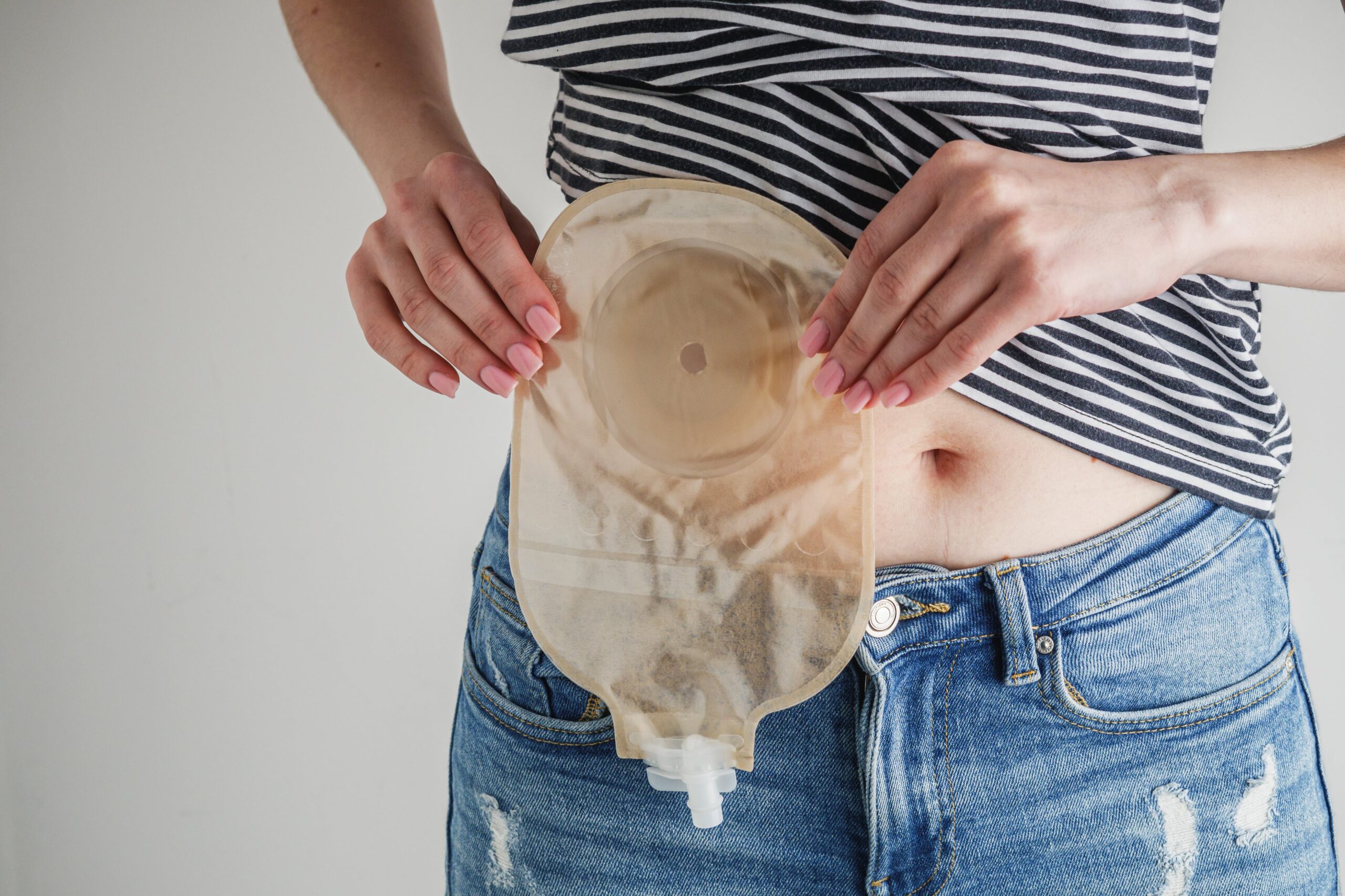 Vrouw met een stomazakje die haar stoma wil verzorgen